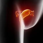 同时查出子宫内膜癌与卵巢癌是转移吗？解读双原发癌生存期与治疗方案