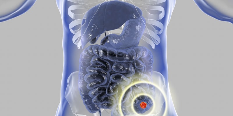 童年癌症放疗后如何预防大肠癌？ASCO最新研究：移动健康干预将结直肠癌筛查率提高3倍