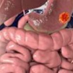二期结肠癌术后要化疗吗？ctDNA检测指导精准治疗，显著降低50%以上复发风险