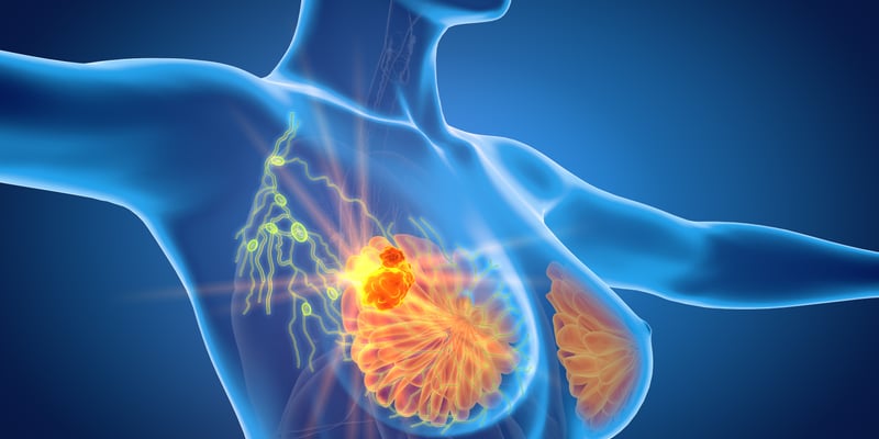 乳腺癌免除前哨淋巴结手术会增加放疗吗？最新研究证实不增加且能实现双重减配