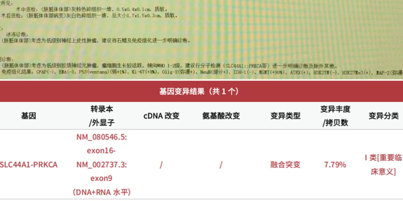 如何避免脑胶质瘤误诊？揭秘SLC44A1-PRKCA基因融合与精准病理诊断