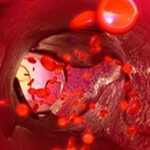 早期乳腺癌ctDNA液体活检有用吗？最新临床研究深度解析与应对指南