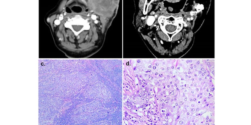 BRCA1基因突变不等于能用PARP抑制剂？一例腮腺癌HRD阴性揭示精准治疗避坑指南