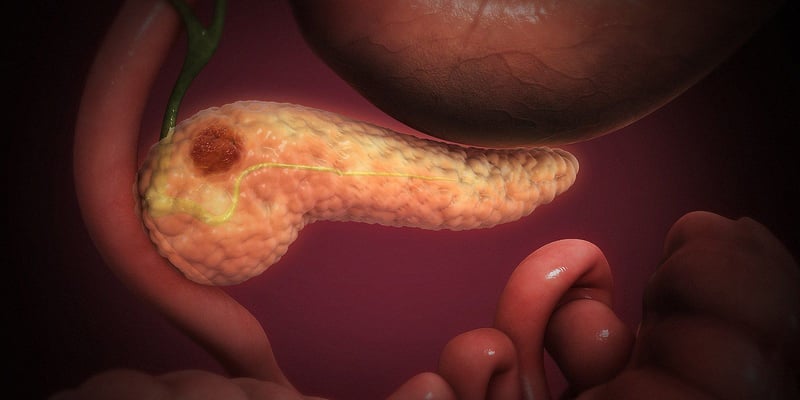 突破“癌王”复发瓶颈！新药Daraxonrasib让转移性胰腺癌生存期翻倍