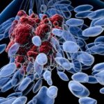 ER+乳腺癌必须化疗吗？ASCO：Prosigna基因检测让2/3高危患者安全免除化疗