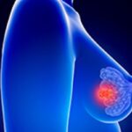 乳腺癌化疗后必须大面积放疗吗？柳叶刀权威10年研究：精准降阶梯放疗安全省心