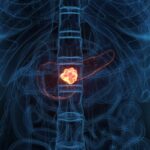 晚期胰腺癌靶向新药Daraxonrasib获EMA加速审评：总生存期翻倍，打破“癌王”治疗困境