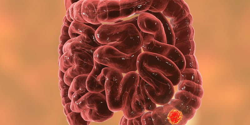 结直肠癌腹膜转移一定要化疗吗？III期CAIRO6研究对比围手术期化疗与单纯手术
