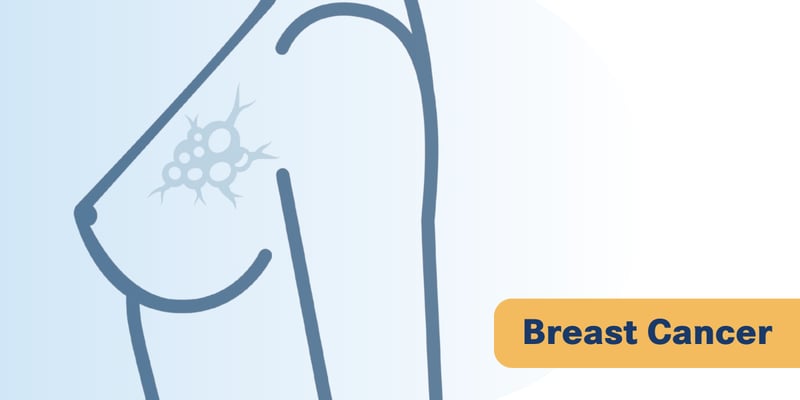 HR+/HER2-乳腺癌化疗怎么选？70基因检测精准预测蒽环类药物获益