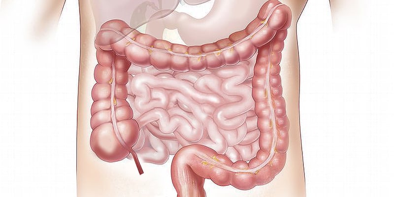 结肠癌化疗后如何防止复发？研究证实结构化运动可降低复发风险并延长生存期