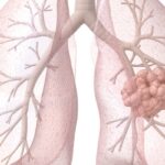 非小细胞肺癌双抗新药Volrustomig临床终止？一线免疫治疗格局与应对指南