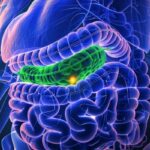 远端胆管癌无法手术怎么办？FDA批准OncoSil微球内放疗突破生存瓶颈