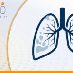 肺鳞癌一线治疗怎么选？西米普利单抗联合化疗突破生存期打破双免神话