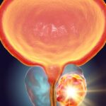 前列腺癌PSA筛查率因何骤降？残障男性早筛困境与应对策略深度解析