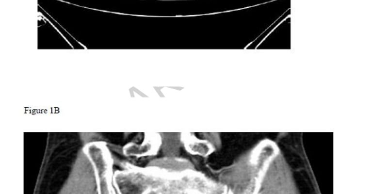 前列腺癌血液检测出NTRK融合却靶向耐药？解析组织验证与精准用药策略