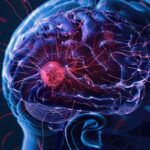 低级别胶质瘤到了40岁必须放化疗吗？JCO重磅研究揭秘分子分型与精准治疗抉择
