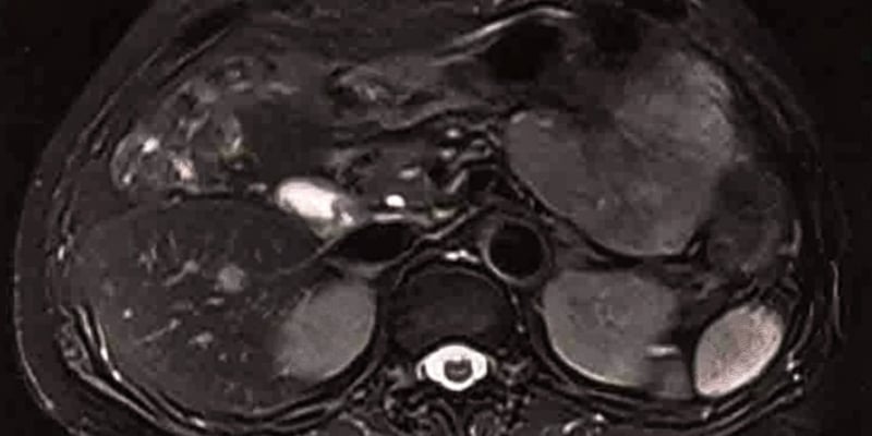 微小混合性肝癌介入治疗无效怎么办？解剖性手术联合靶免辅助治疗全解析
