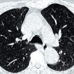 肺结节良恶性难判断？AI影像组学筛查准确率超基因检测，避免盲目穿刺