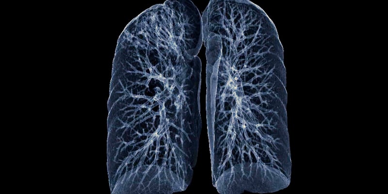 肺癌筛查怎么选？NEJM发布IARC国际权威指南：低剂量CT筛查利弊全解析
