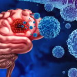 小细胞肺癌脑转移做全脑放疗还是立体定向？最新III期研究揭示生存期翻倍策略
