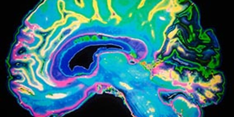 小细胞肺癌一定要做全脑放疗吗？III期临床证实定期核磁监测可替代PCI