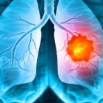 小细胞肺癌迎来皮下注射新突破！塔拉妥单抗15mg疗效媲美静脉且无需住院监测